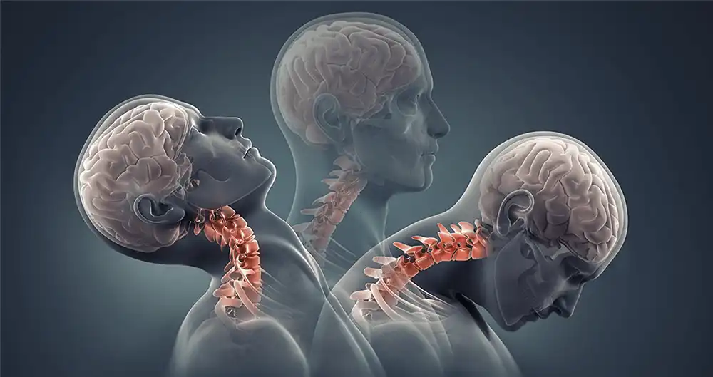 Recognizing Hidden Injuries After a Crash in Hackensack: From Whiplash to Nerve Pain